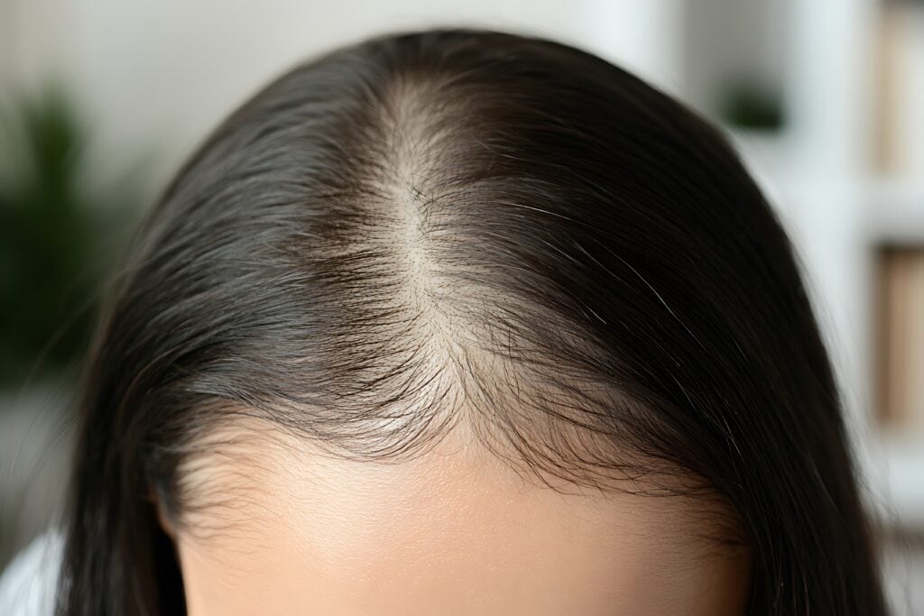 Understanding the common causes of thinning hair